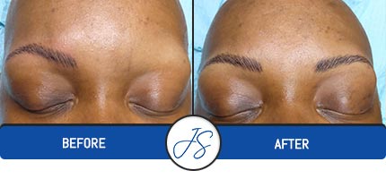 Alopecia Cosmetics Procedure Near Me in Middleburg Heights, OH Alopecia Cosmetics Procedure Near Me in Middleburg Heights, OH