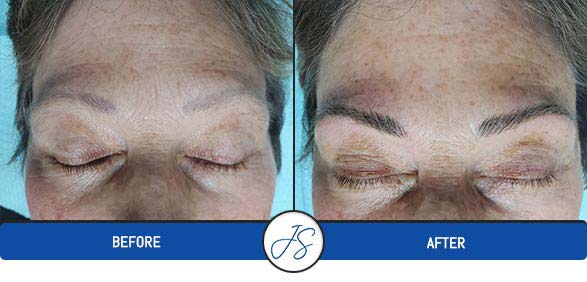 Alopecia Cosmetics Procedure Near Me in Middleburg Heights, OH Alopecia Cosmetics Procedure Near Me in Middleburg Heights, OH
