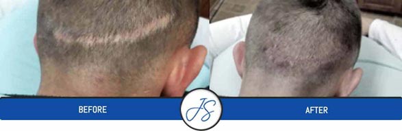 Alopecia Specialist Near Me in Cleveland OH - Middleburg Heights, OH Alopecia Specialist Near Me in Cleveland OH - Middleburg Heights, OH