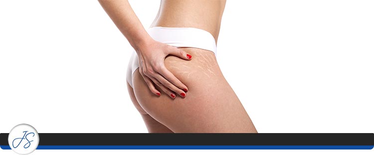 Stretch Mark Camouflage Treatment Near Me in Middleburg Heights, OH Stretch Mark Camouflage Treatment Near Me in Middleburg Heights, OH