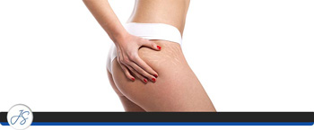 Stretch Mark Camouflage Treatment Near Me in Middleburg Heights, OH Stretch Mark Camouflage Treatment Near Me in Middleburg Heights, OH