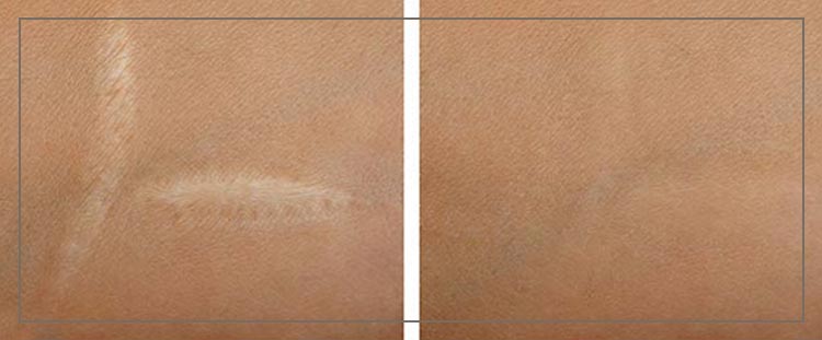 Scar Camouflage Pigmentation Near Me in Cleveland, OH Scar Camouflage Pigmentation Near Me in Cleveland, OH