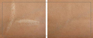 Scar Camouflage Pigmentation Near Me in Cleveland, OH Scar Camouflage Pigmentation Near Me in Cleveland, OH