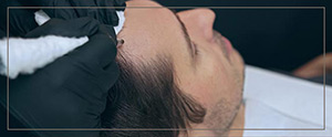 Scalp Micropigmentation Specialist Near Me in Cleveland OH Scalp Micropigmentation Specialist Near Me in Cleveland OH