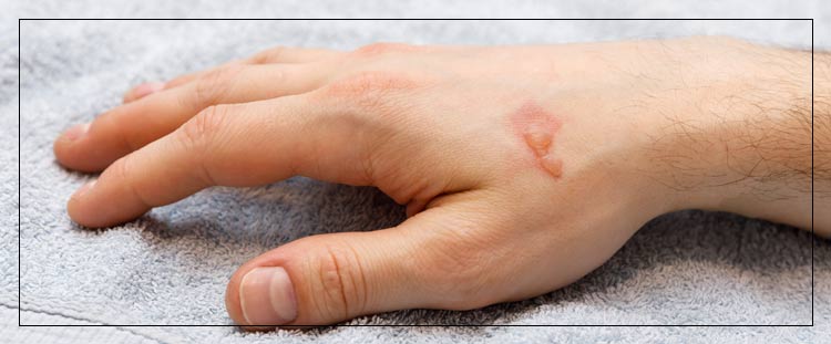 Burn Scar Camouflage Treatment Near Me in Cleveland, OH Burn Scar Camouflage Treatment Near Me in Cleveland, OH