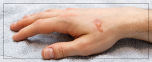 Burn Scar Camouflage Treatment Near Me in Cleveland, OH Burn Scar Camouflage Treatment Near Me in Cleveland, OH