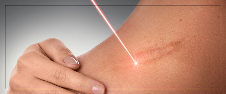 Scar Cover-Up Treatment Specialist Near Me in Cleveland, OH Scar Cover-Up Treatment Specialist Near Me in Cleveland, OH