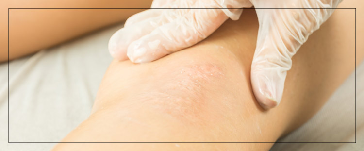 Micropigmentation Scar Camouflage Near Me in Cleveland, OH Micropigmentation Scar Camouflage Near Me in Cleveland, OH
