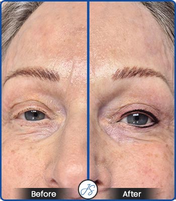 Classic Permanent Eyeliner Before and After Client Photos of Jaudon Sunde in Cleveland, OH 