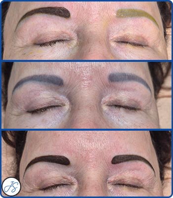 Pigment Removal and Color Correction Before and After Client Photos of Jaudon Sunde in Cleveland, OH 