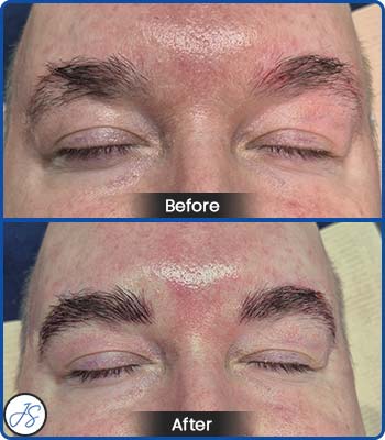 Microblading Brows Before and After Client Photos of Jaudon Sunde in Cleveland, OH 
