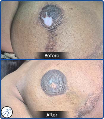 Scar Camouflage Before and After Client Photos of Jaudon Sunde in Cleveland, OH 