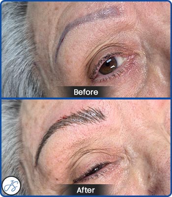 Pigment Removal and Color Correction Before and After Client Photos of Jaudon Sunde in Cleveland, OH 