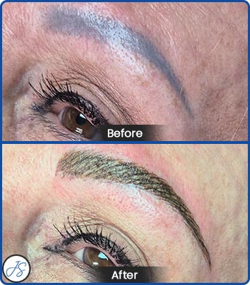 Pigment Removal and Color Correction Before and After Client Photos of Jaudon Sunde in Cleveland, OH 