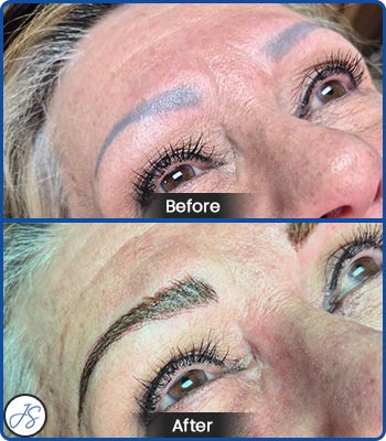Pigment Removal and Color Correction Before and After Client Photos of Jaudon Sunde in Cleveland, OH 
