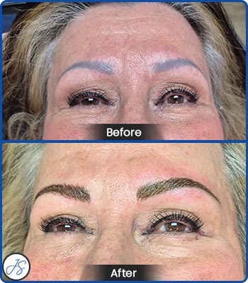 Pigment Removal and Color Correction Before and After Client Photos of Jaudon Sunde in Cleveland, OH 