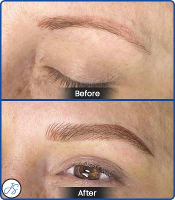 Pigment Removal and Color Correction Before and After Client Photos of Jaudon Sunde in Cleveland, OH 