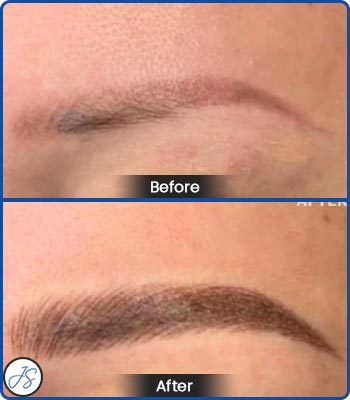 Pigment Removal and Color Correction Before and After Client Photos of Jaudon Sunde in Cleveland, OH 