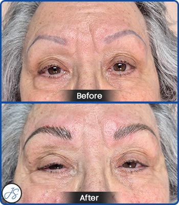 Pigment Removal and Color Correction Before and After Client Photos of Jaudon Sunde in Cleveland, OH 