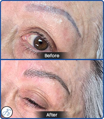 Pigment Removal and Color Correction Before and After Client Photos of Jaudon Sunde in Cleveland, OH 