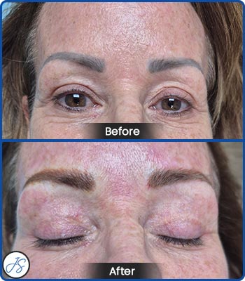 Pigment Removal and Color Correction Before and After Client Photos of Jaudon Sunde in Cleveland, OH 