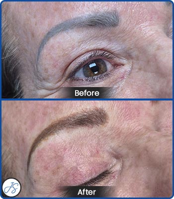 Pigment Removal and Color Correction Before and After Client Photos of Jaudon Sunde in Cleveland, OH 