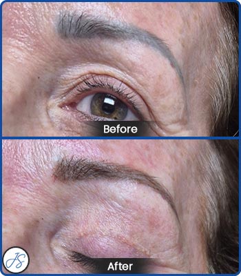 Pigment Removal and Color Correction Before and After Client Photos of Jaudon Sunde in Cleveland, OH 